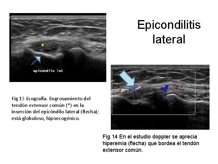 * Epicondilitis lateral Fig 13 Ecografía. Engrosamiento del tendón extensor común (*) en la