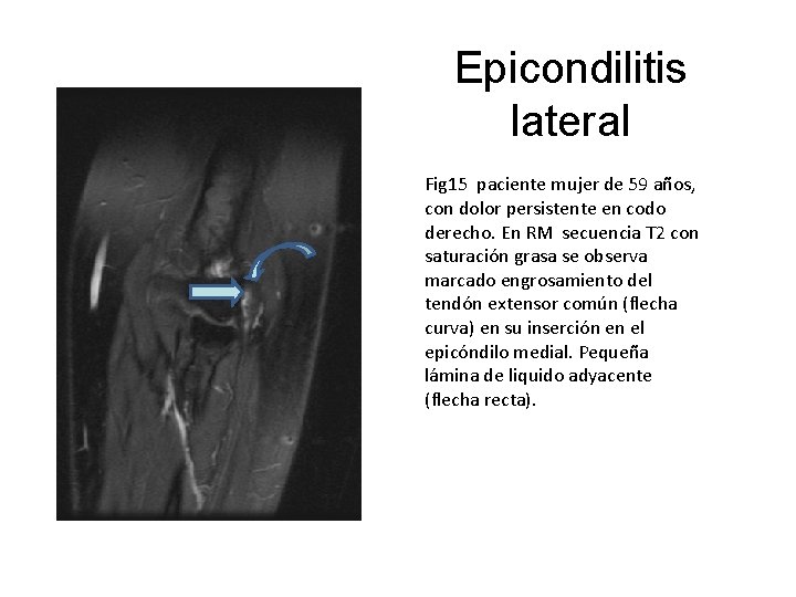 Epicondilitis lateral Fig 15 paciente mujer de 59 años, con dolor persistente en codo