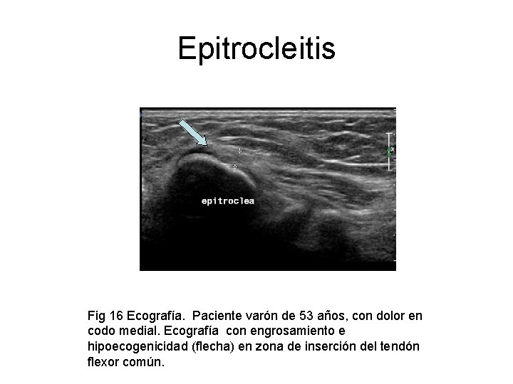 Epitrocleitis Fig 16 Ecografía. Paciente varón de 53 años, con dolor en codo medial.