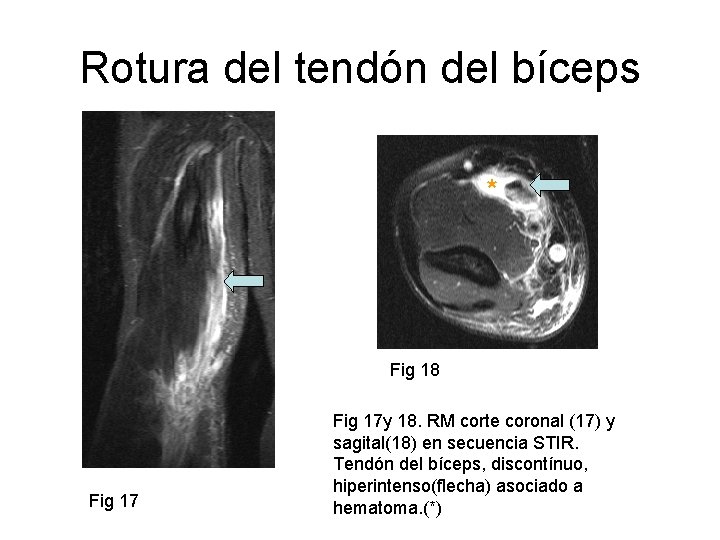Rotura del tendón del bíceps * Fig 18 Fig 17 y 18. RM corte
