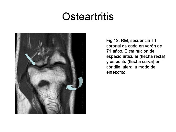 Osteartritis Fig 19. RM, secuencia T 1 coronal de codo en varón de 71