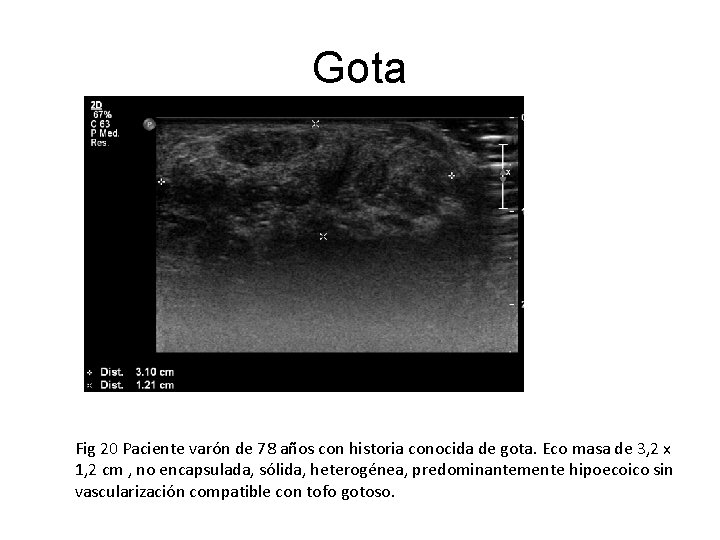 Gota Fig 20 Paciente varón de 78 años con historia conocida de gota. Eco