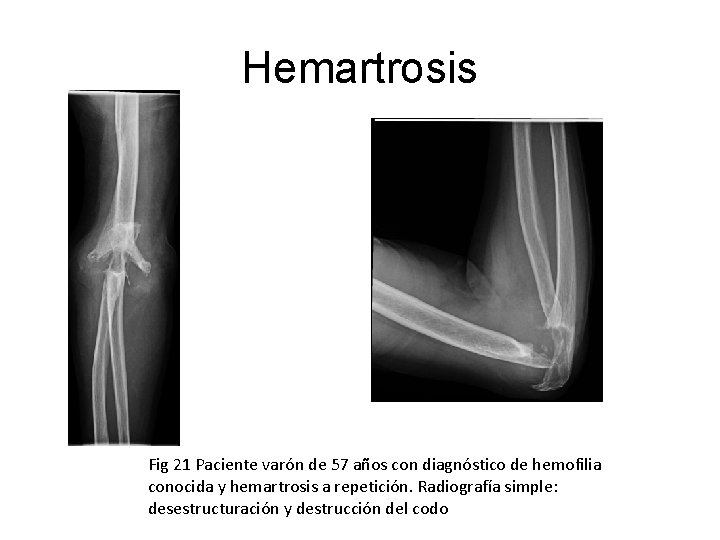 Hemartrosis Fig 21 Paciente varón de 57 años con diagnóstico de hemofilia conocida y