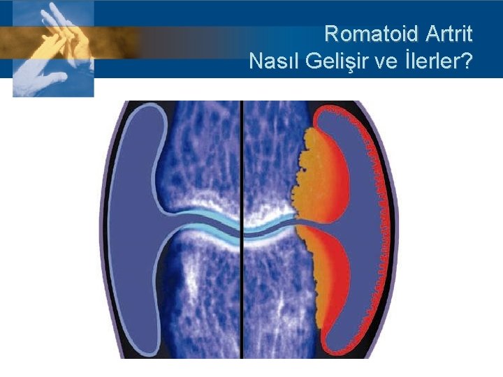 Romatoid Artrit Nasıl Gelişir ve İlerler? 