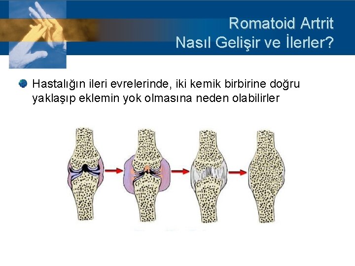 Romatoid Artrit Nasıl Gelişir ve İlerler? Hastalığın ileri evrelerinde, iki kemik birbirine doğru yaklaşıp