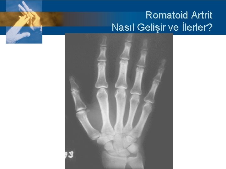 Romatoid Artrit Nasıl Gelişir ve İlerler? 