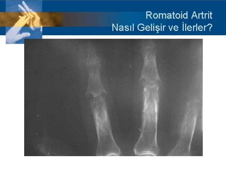 Romatoid Artrit Nasıl Gelişir ve İlerler? 