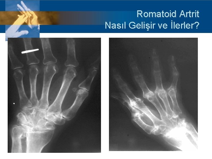 Romatoid Artrit Nasıl Gelişir ve İlerler? 