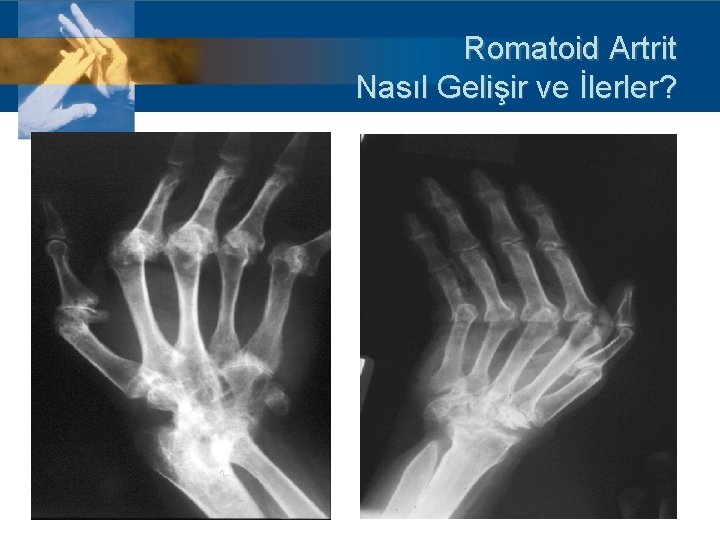 Romatoid Artrit Nasıl Gelişir ve İlerler? 