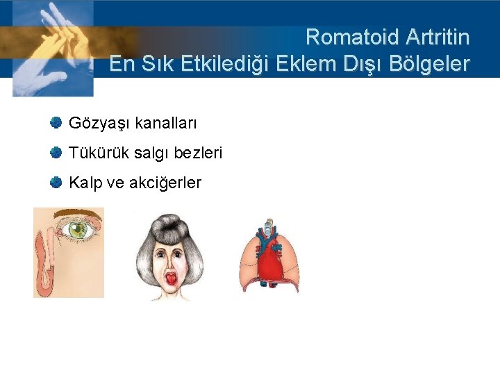 Romatoid Artritin En Sık Etkilediği Eklem Dışı Bölgeler Gözyaşı kanalları Tükürük salgı bezleri Kalp