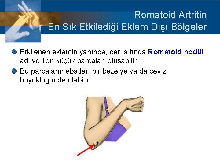 Romatoid Artritin En Sık Etkilediği Eklem Dışı Bölgeler Etkilenen eklemin yanında, deri altında Romatoid