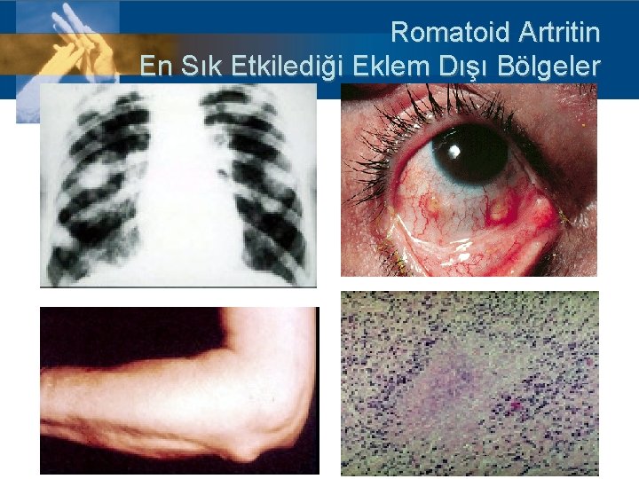 Romatoid Artritin En Sık Etkilediği Eklem Dışı Bölgeler 