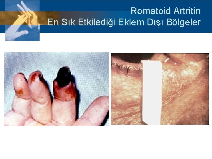 Romatoid Artritin En Sık Etkilediği Eklem Dışı Bölgeler 