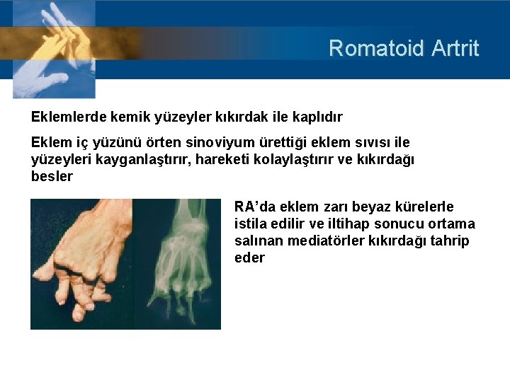 Romatoid Artrit Eklemlerde kemik yüzeyler kıkırdak ile kaplıdır Eklem iç yüzünü örten sinoviyum ürettiği