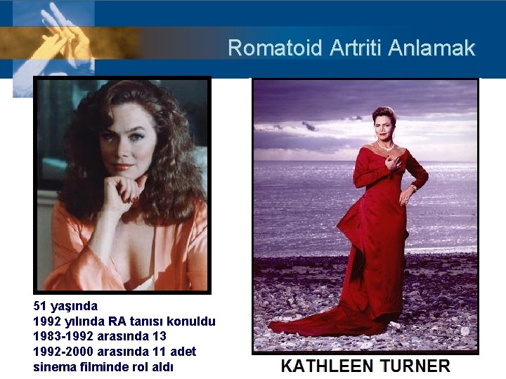 Romatoid Artriti Anlamak 51 yaşında 1992 yılında RA tanısı konuldu 1983 -1992 arasında 13