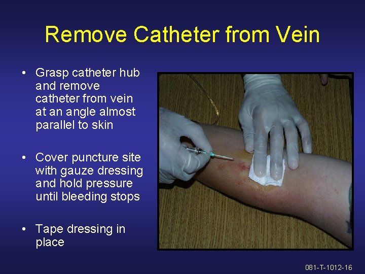 Remove Catheter from Vein • Grasp catheter hub and remove catheter from vein at