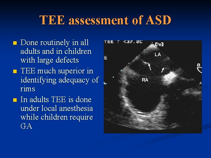 TEE assessment of ASD n n n Done routinely in all adults and in