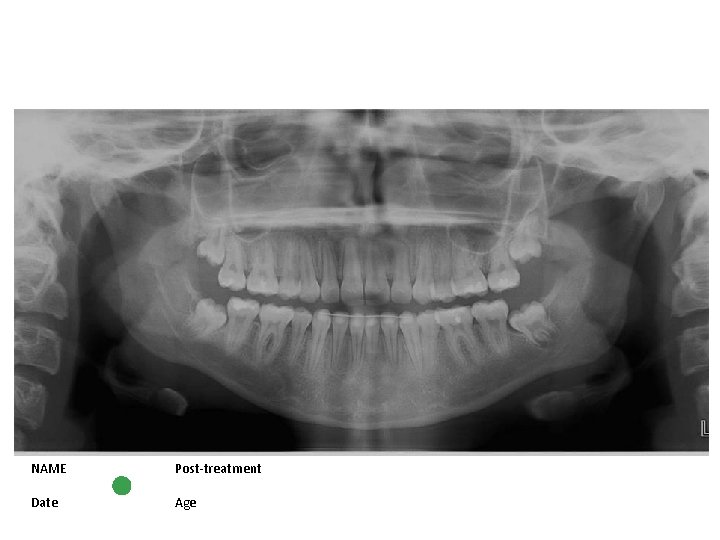 NAME Post-treatment Date Age 