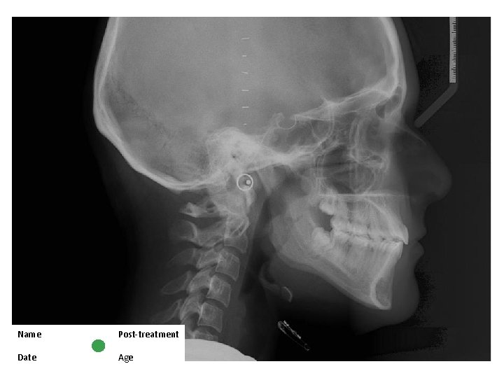 Name Post-treatment Date Age 