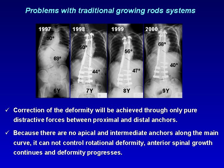 Problems with traditional growing rods systems 1997 1998 1999 2000 50º 68º 50º 56º