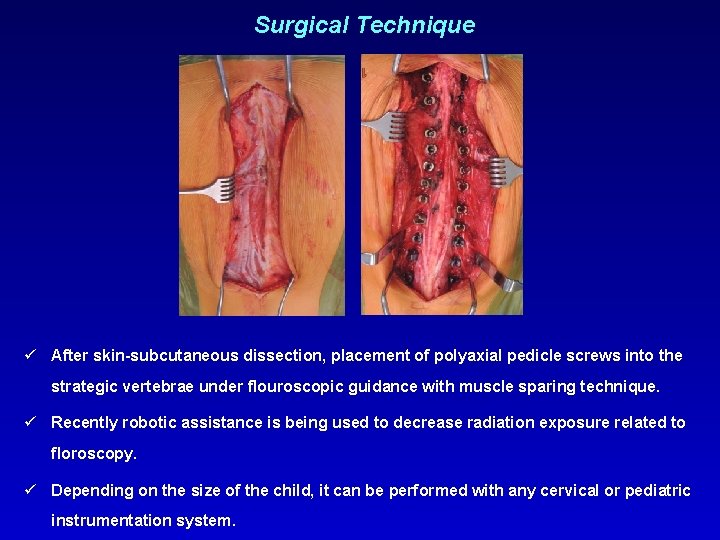 Surgical Technique ü After skin-subcutaneous dissection, placement of polyaxial pedicle screws into the strategic