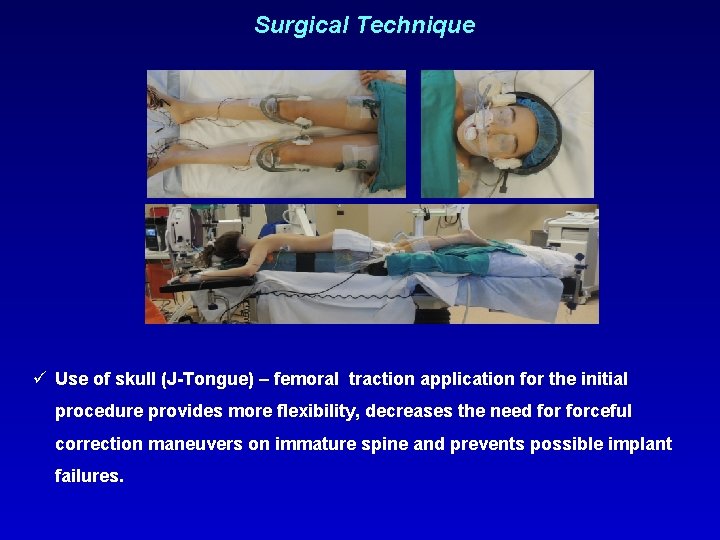 Surgical Technique ü Use of skull (J-Tongue) – femoral traction application for the initial