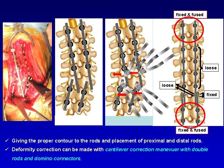 fixed & fused loose fixed & fused ü Giving the proper contour to the