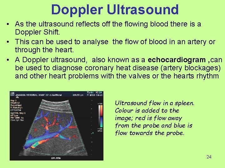 Doppler Ultrasound • As the ultrasound reflects off the flowing blood there is a