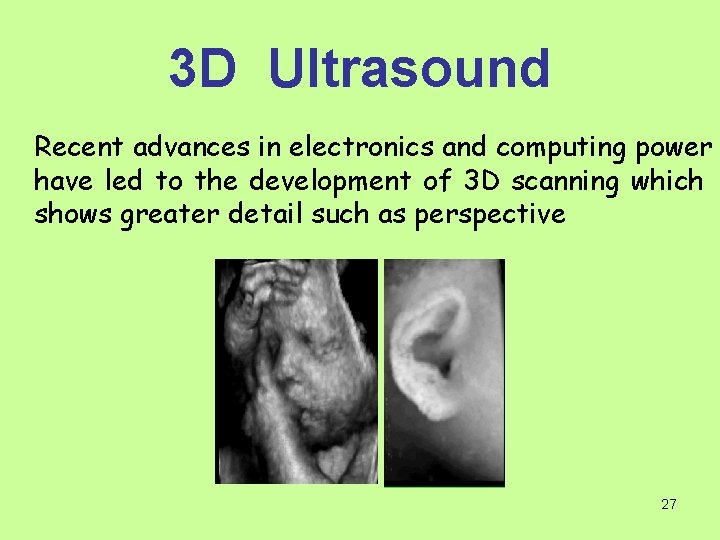 3 D Ultrasound Recent advances in electronics and computing power have led to the