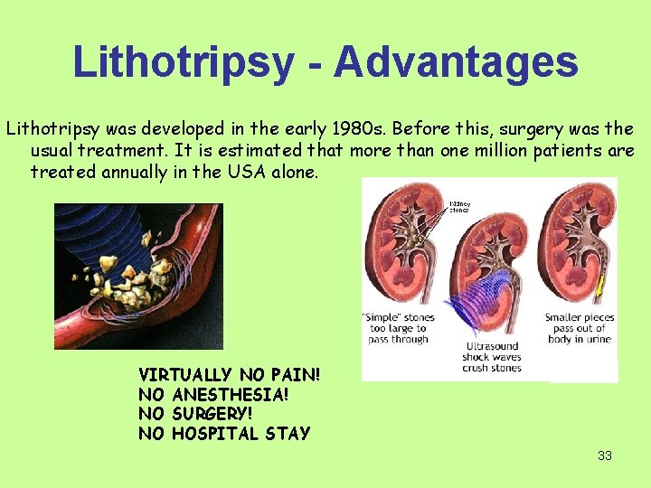 Lithotripsy - Advantages Lithotripsy was developed in the early 1980 s. Before this, surgery