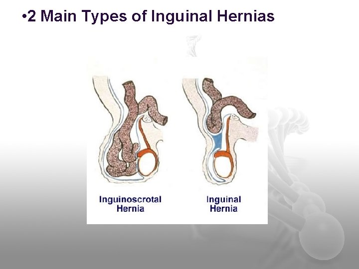  • 2 Main Types of Inguinal Hernias 