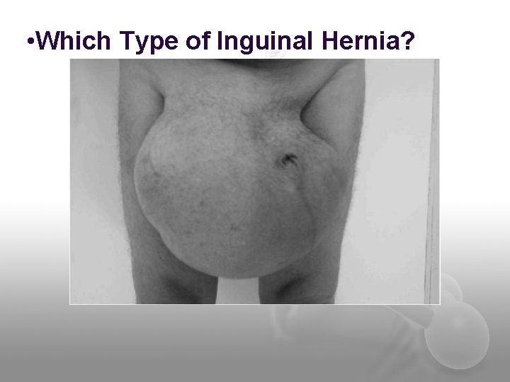  • Which Type of Inguinal Hernia? 