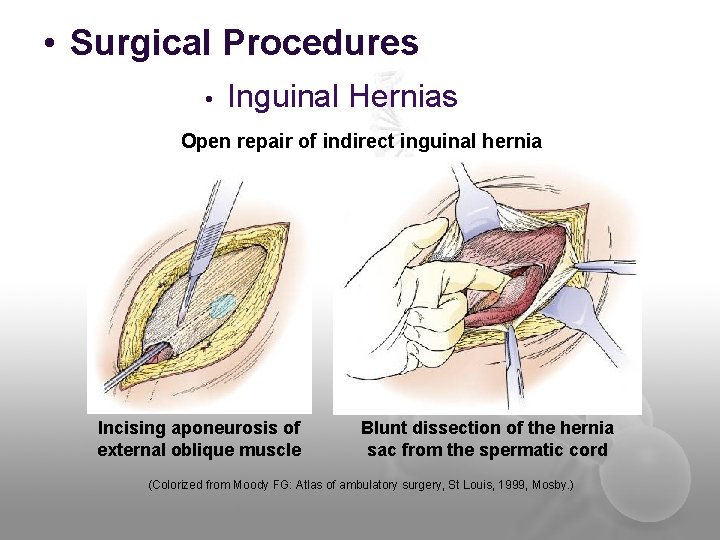  • Surgical Procedures • Inguinal Hernias Open repair of indirect inguinal hernia Incising