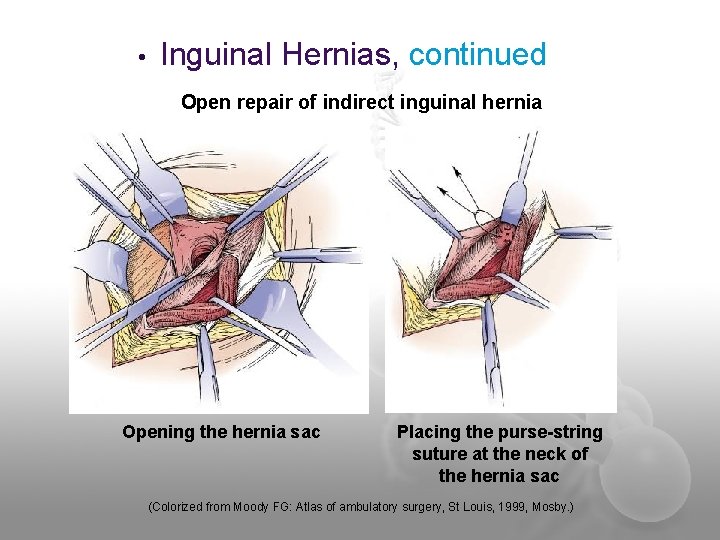  • Inguinal Hernias, continued Open repair of indirect inguinal hernia Opening the hernia