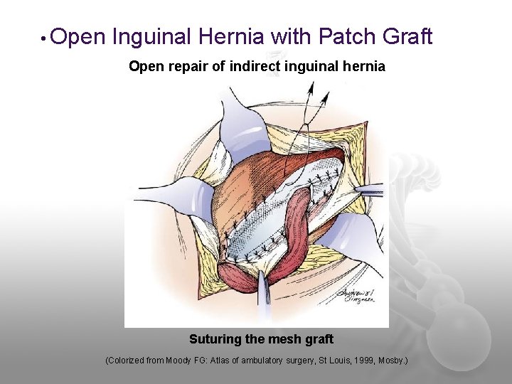  • Open Inguinal Hernia with Patch Graft Open repair of indirect inguinal hernia