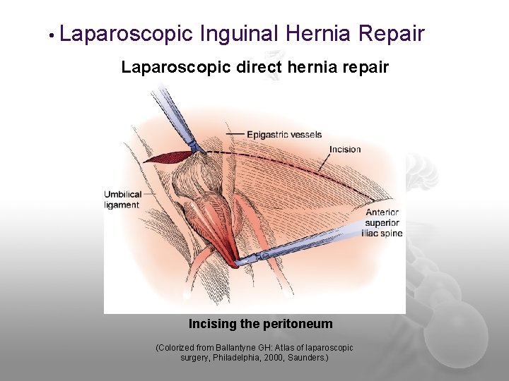  • Laparoscopic Inguinal Hernia Repair Laparoscopic direct hernia repair Incising the peritoneum (Colorized
