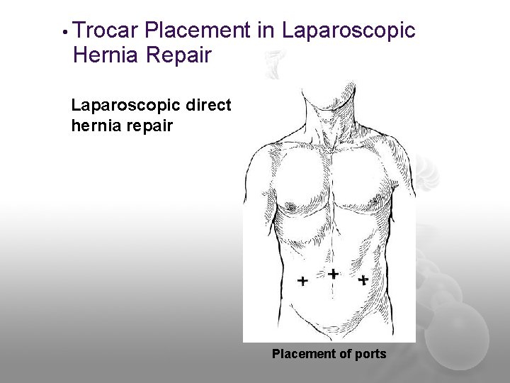  • Trocar Placement in Laparoscopic Hernia Repair Laparoscopic direct hernia repair Placement of