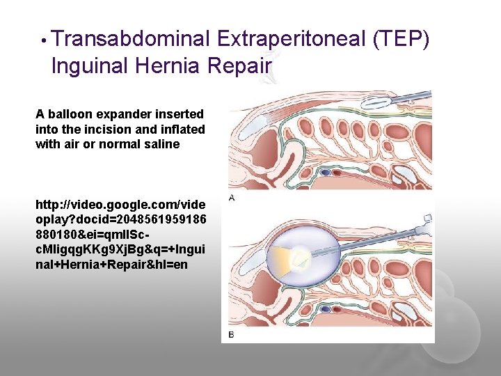  • Transabdominal Extraperitoneal (TEP) Inguinal Hernia Repair A balloon expander inserted into the