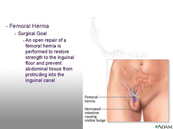 • Femoral Hernia • Surgical Goal • An open repair of a femoral