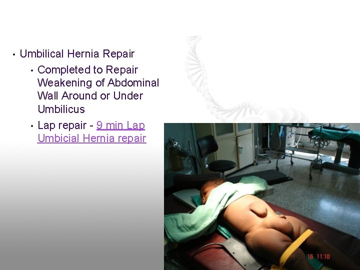  • Umbilical Hernia Repair • Completed to Repair Weakening of Abdominal Wall Around