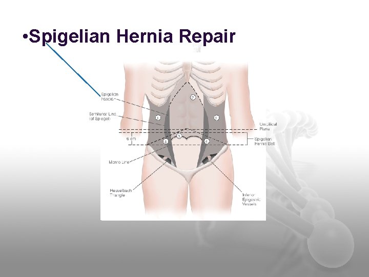  • Spigelian Hernia Repair 