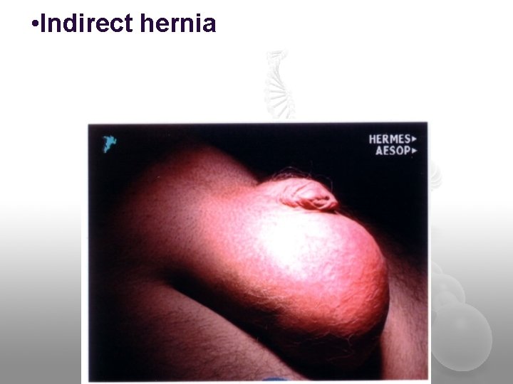  • Indirect hernia 