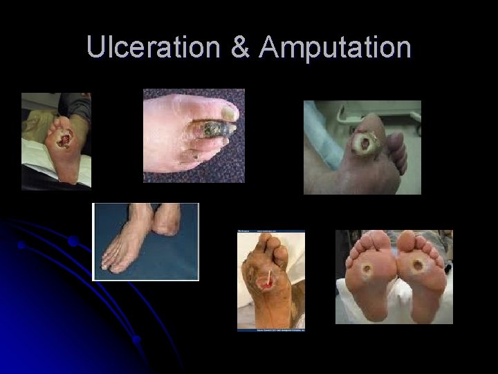 Ulceration & Amputation 