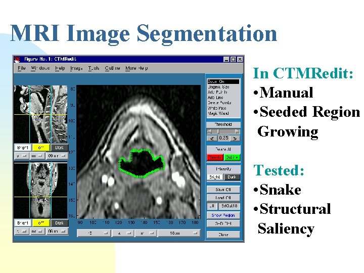 MRI Image Segmentation In CTMRedit: • Manual • Seeded Region Growing Tested: • Snake