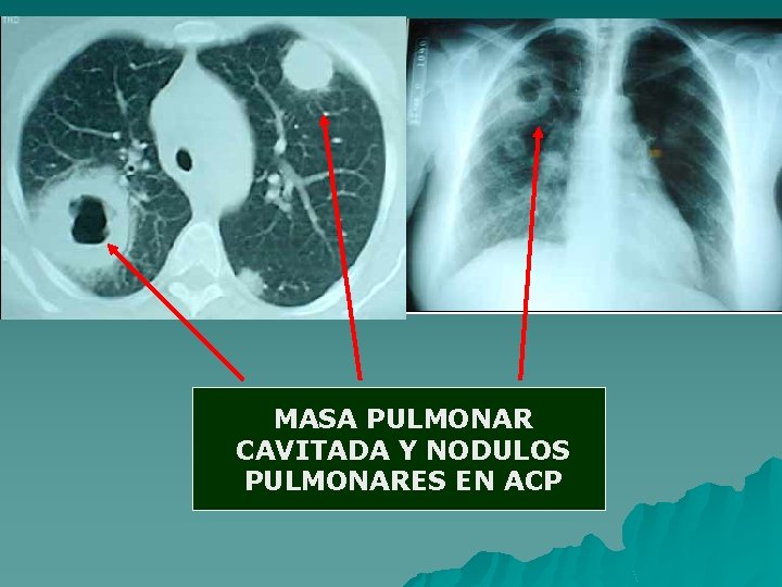 MASA PULMONAR CAVITADA Y NODULOS PULMONARES EN ACP 