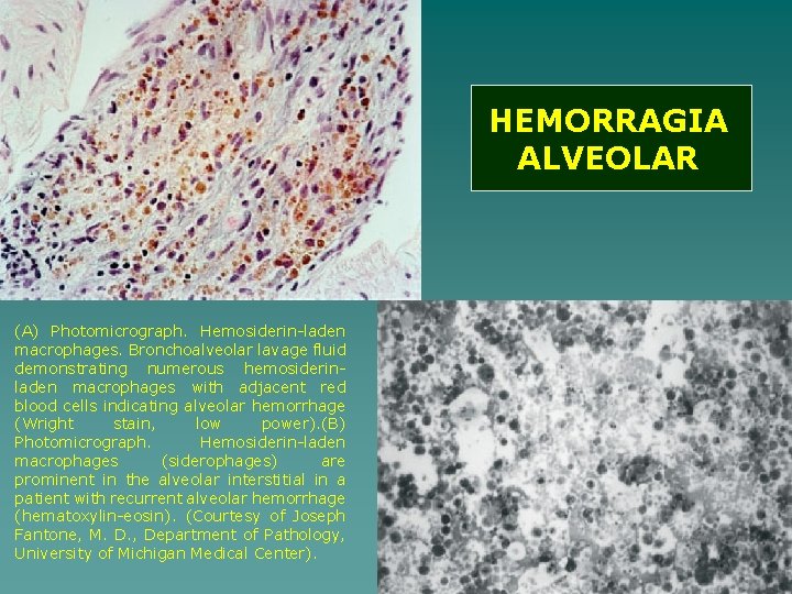 HEMORRAGIA ALVEOLAR (A) Photomicrograph. Hemosiderin-laden macrophages. Bronchoalveolar lavage fluid demonstrating numerous hemosiderinladen macrophages with