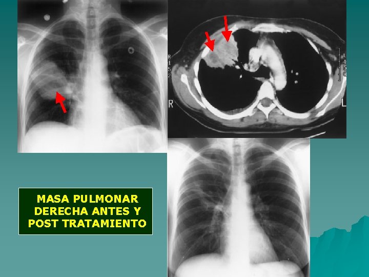 MASA PULMONAR DERECHA ANTES Y POST TRATAMIENTO 