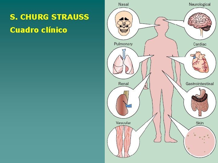 S. CHURG STRAUSS Cuadro clínico 