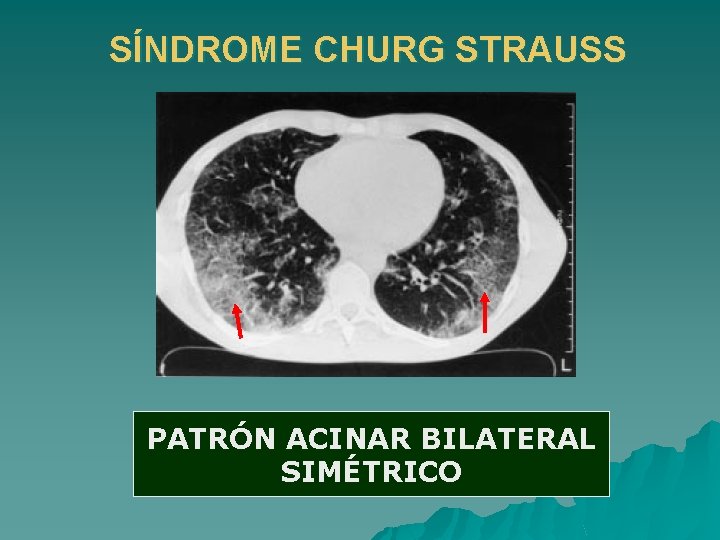 SÍNDROME CHURG STRAUSS PATRÓN ACINAR BILATERAL SIMÉTRICO 