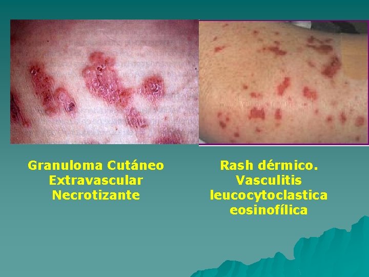 Granuloma Cutáneo Extravascular Necrotizante Rash dérmico. Vasculitis leucocytoclastica eosinofílica 